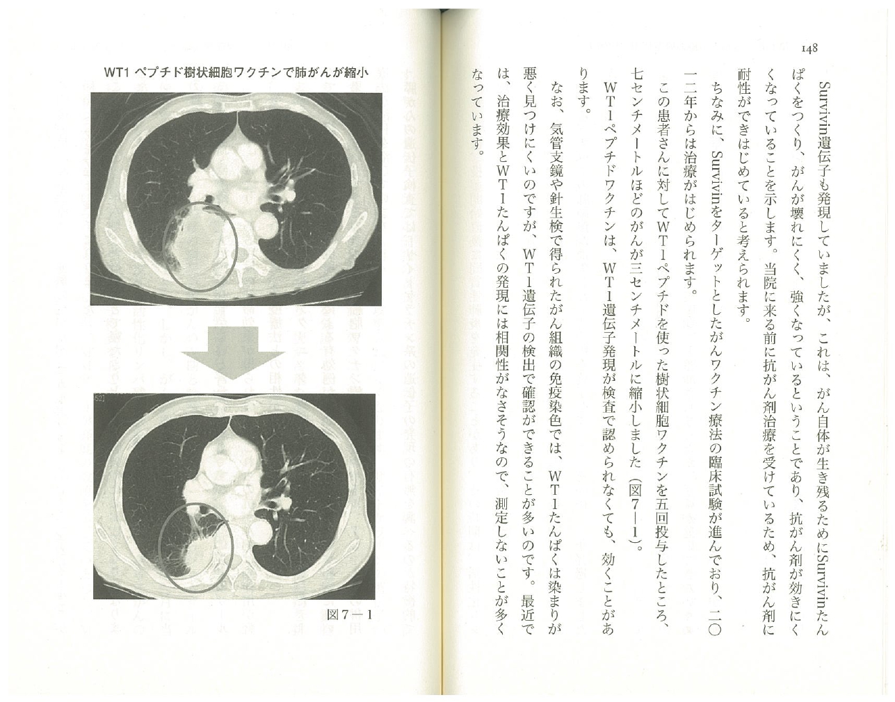 瘤縮小四厘米