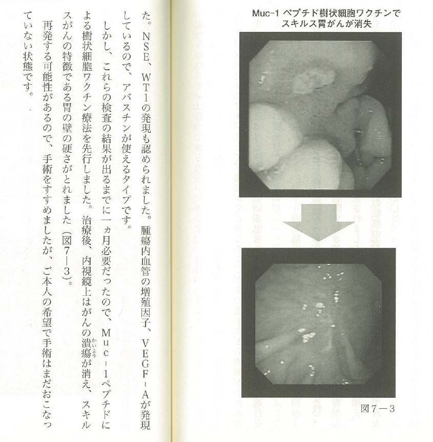 胃癌治療